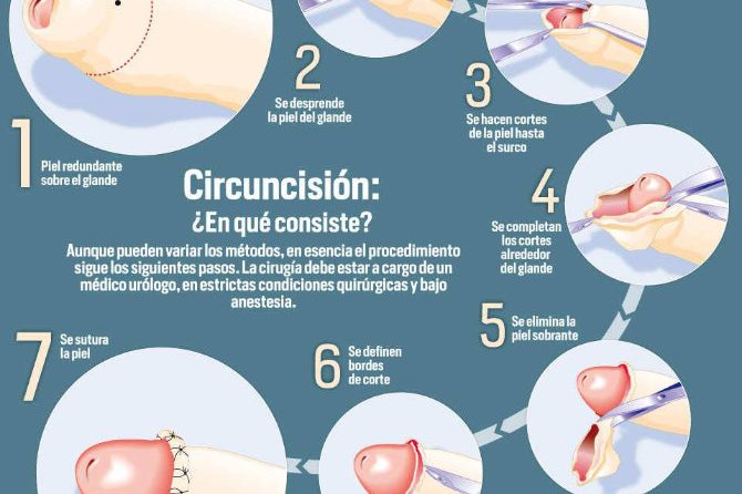 La circuncisión